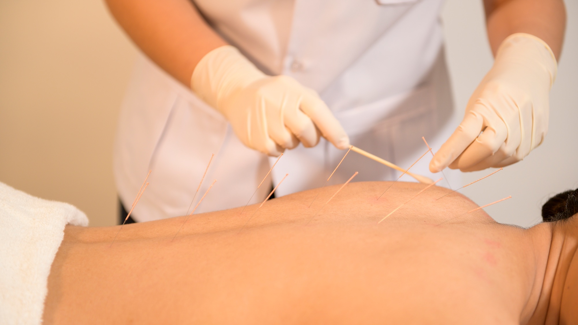 woman received acupuncture treatment on back by therapist